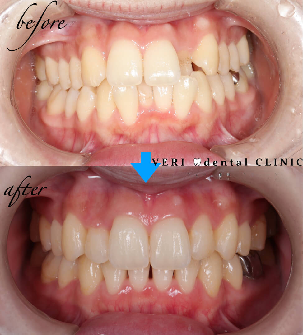 インビザラインフル（抜歯を伴う矯正治療）70万円（税別）の症例