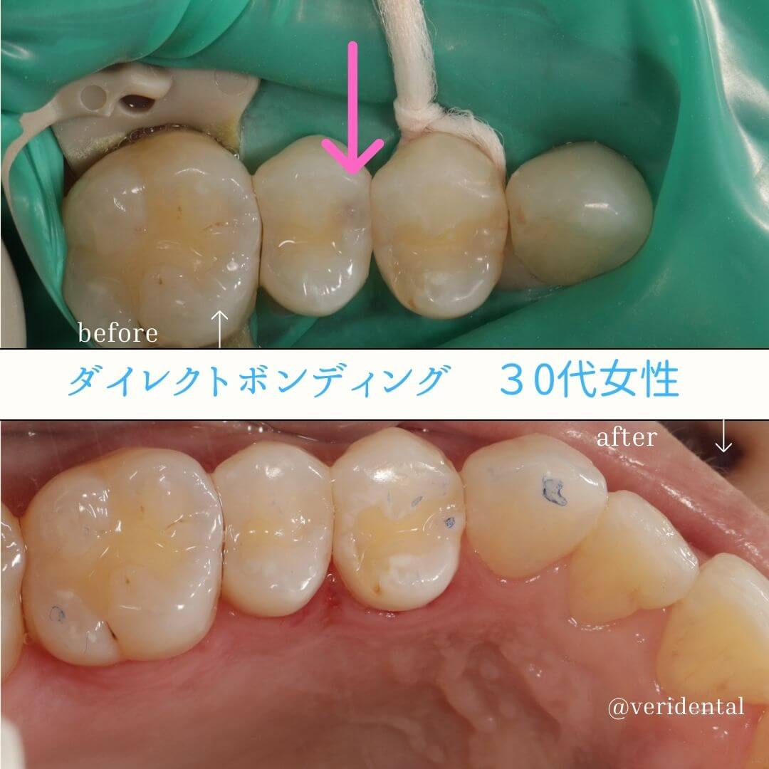 ダイレクトボンディング2級の治療 - ヴェリ歯科クリニック
