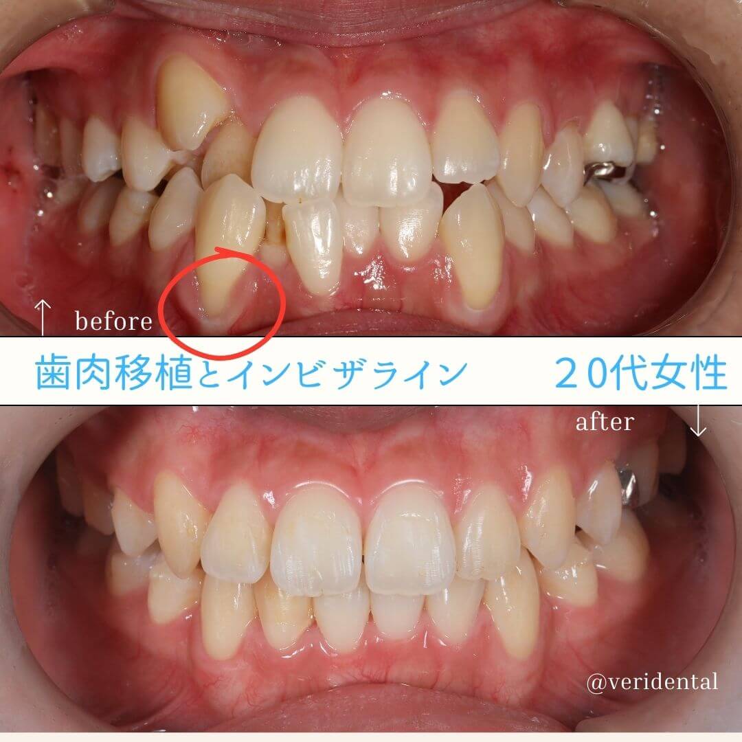 歯肉移植で下がった歯ぐきをとりもどす治療について知ってほしい３つのこと - ヴェリ歯科クリニック