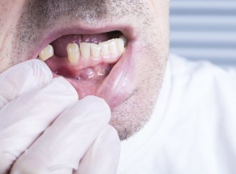 Closeup teeth, dental health care clinic with missing tooth