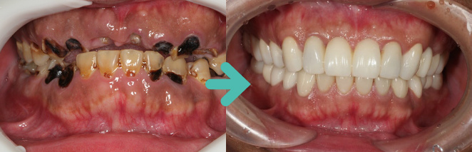 ひどい虫歯をなるべくインプラントをしないで治療した症例（30代 男性）