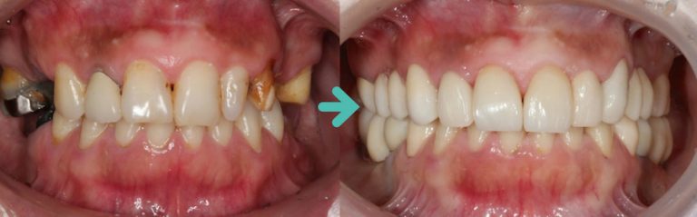 ひどい虫歯の治療や審美歯科の症例集 巣鴨の歯医者・歯科医院