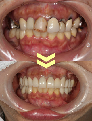 前歯の審美治療