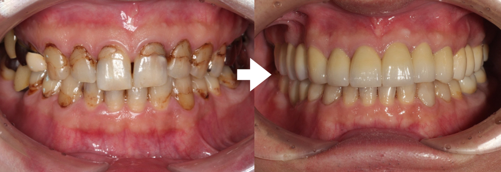 ひどい虫歯の症例５（男性４０代）