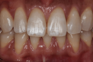 前歯についた白濁やシミ、斑点、ホワイトスポットがどうしても取れない時に知っておきたい治療法