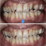 矮小歯とすきっ歯を削らずに治療した症例