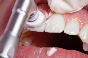 歯医者に定期的に行く人、痛くなったら歯医者に行く人の違い